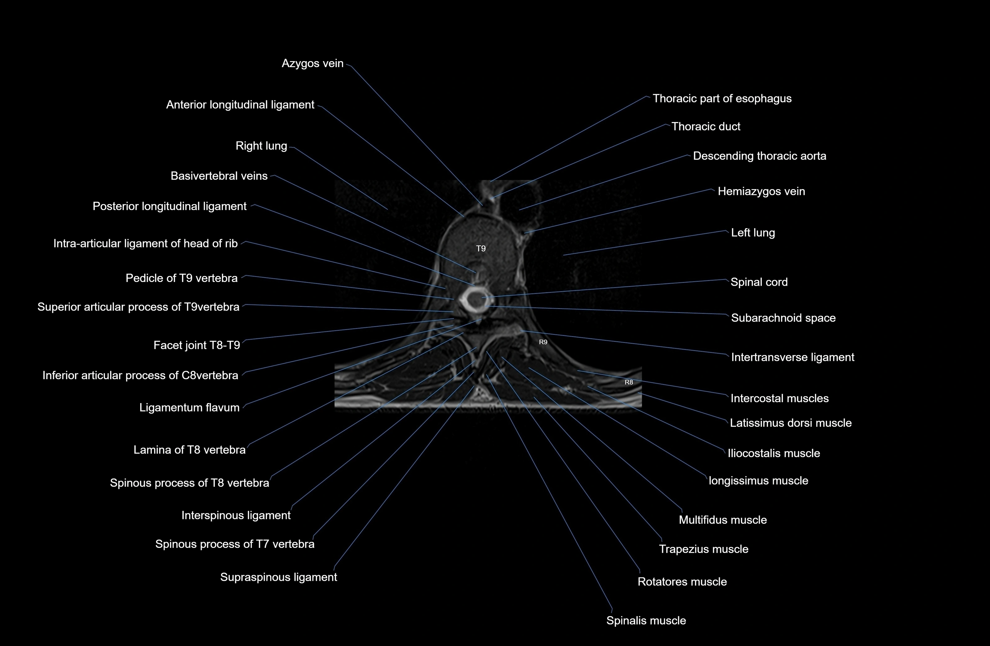 MRI thoracic spine axial  cross sectional anatomy 3T radiology  image-img-00001-00058.webp